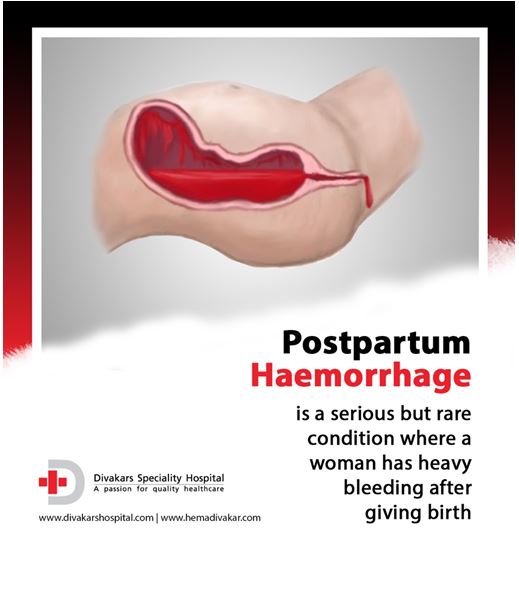 Bleeding at birth…What is Postpartum Hemorrhage?