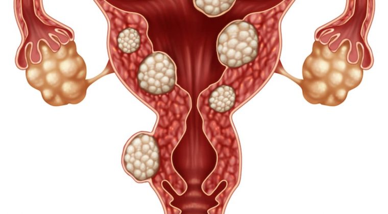 Options for treating fibroids