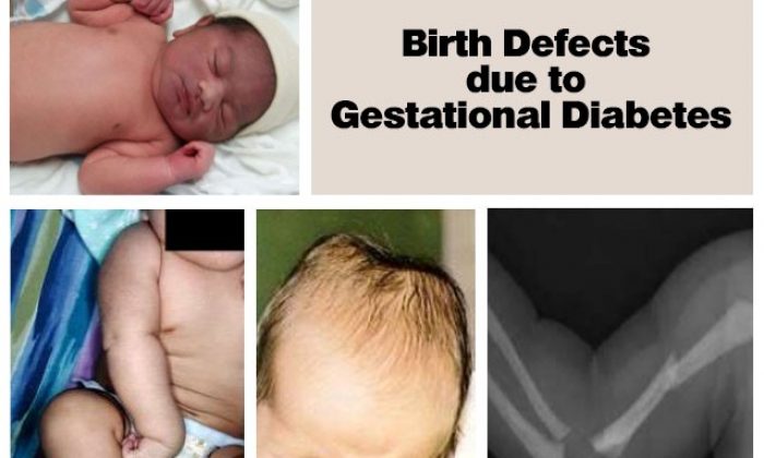 Birth Defects and Gestational Diabetes