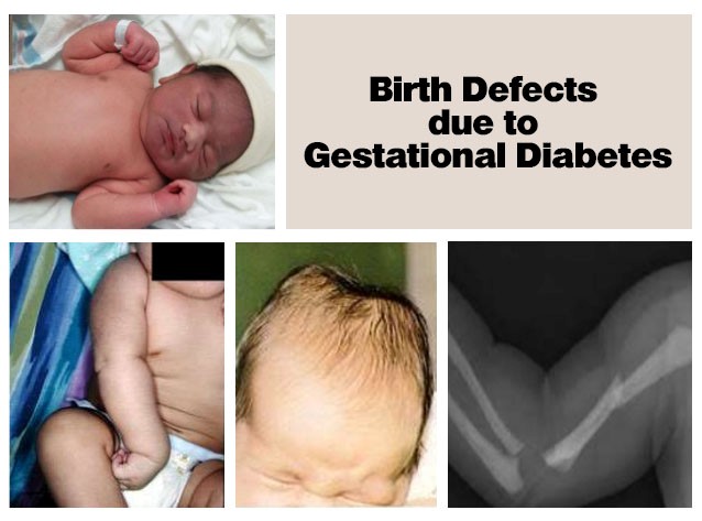 Birth Defects and Gestational Diabetes