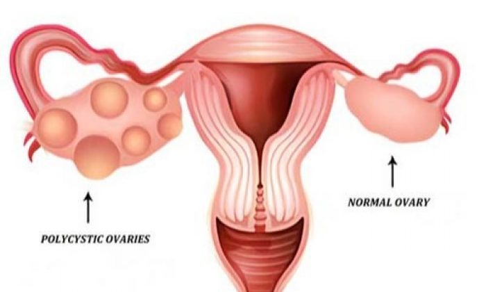 PCOS – Causes and Possible Complications
