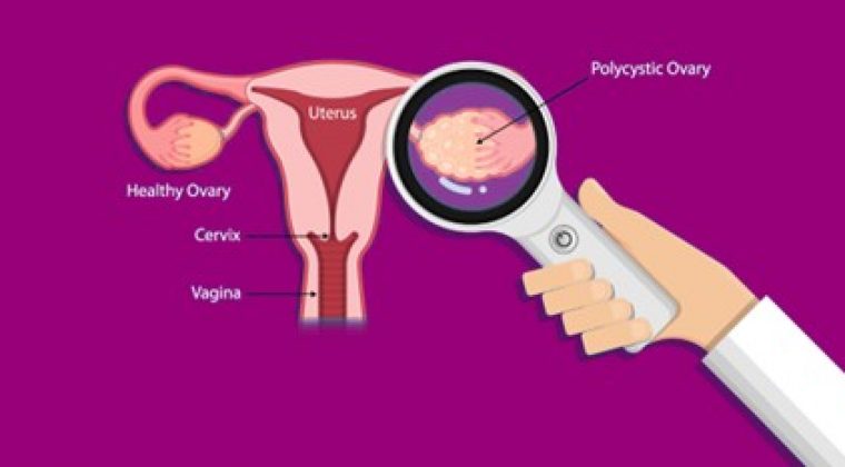 PCOS – Diagnosis and Treatment