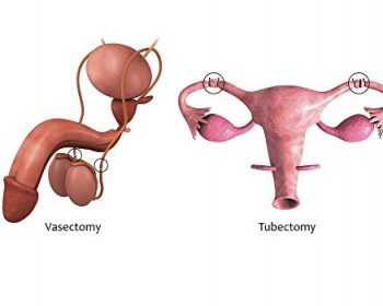 Male and Female Sterilization
