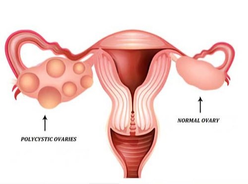 PCOS – Causes and Possible Complications