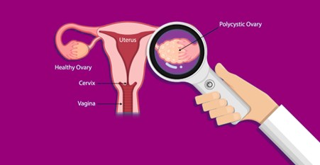 PCOS – Diagnosis and Treatment